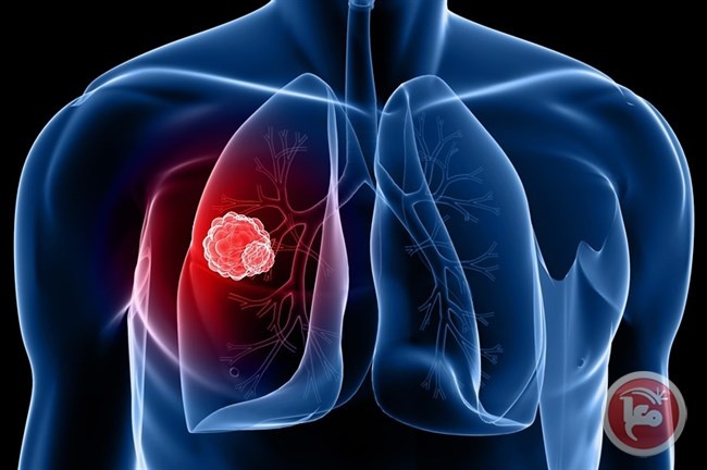 باحثون يكتشفون- &quot;قاتل خفي&quot; يسبب سرطانات الرئة لغير المدخنين 